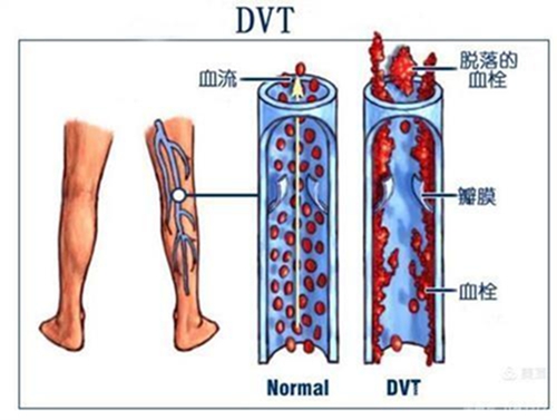 腿腫莫忘了他1.jpg 腿腫莫忘了他1.jpg