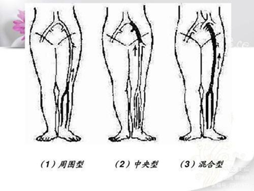 腿腫莫忘了他3.jpg 腿腫莫忘了他3.jpg